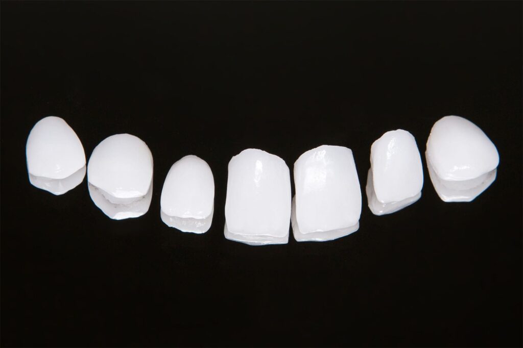 dental laminates